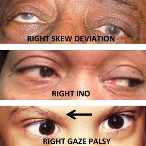 Lesson: A Stepwise Approach to Evaluating Diplopia and Other Ocular Motility Abnormalities