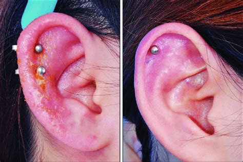 Complications Of Ear Piercing: Perichondritis And Ear, 40% OFF