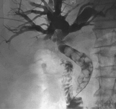 Acute Cholangitis | Concise Medical Knowledge