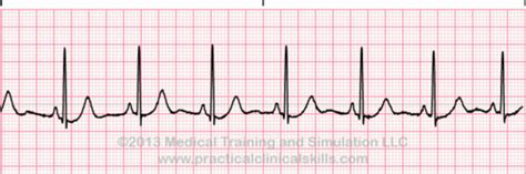 EKG Practice Strips and Treatment Flashcards | Quizlet