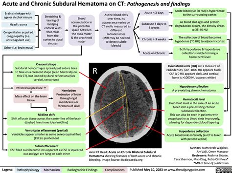 Chronic Subdural Hematoma Vs Acute