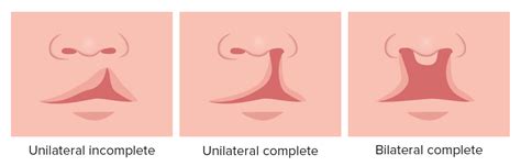 Cleft Lip and Cleft Palate | Concise Medical Knowledge