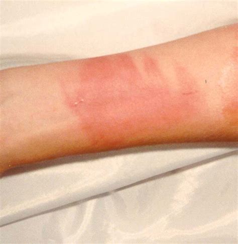 First Degree Burn On Arm