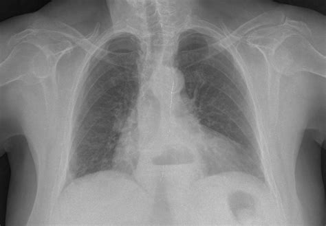 El Blog de Isa y Juan: Imagen radiográfica de la hernia de hiato