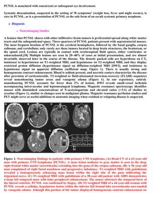 Topic of the month.... Primary CNS lymphoma | PDF