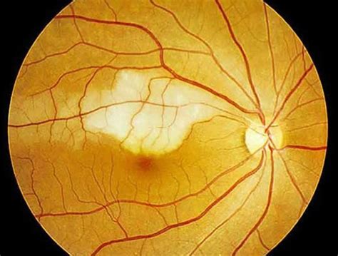 Retinal artery occlusion causes, symptoms, diagnosis, treatment & prognosis