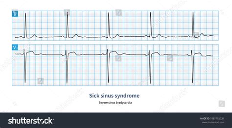 22 Sick sinus syndrome ekg 图片、库存照片和矢量图 | Shutterstock