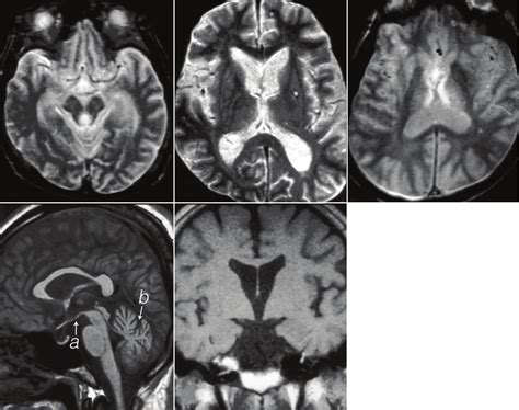 MRI in Wernicke encephalopathy. In T2-weighted axial image, abnormal ...