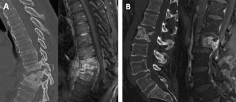 Spinal Tumors: Diagnosis and Treatment : JAAOS - Journal of the American Academy of Orthopaedic ...