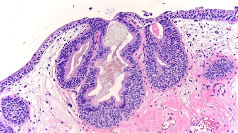 Pathology Outlines - Cystitis cystica and cystitis glandularis