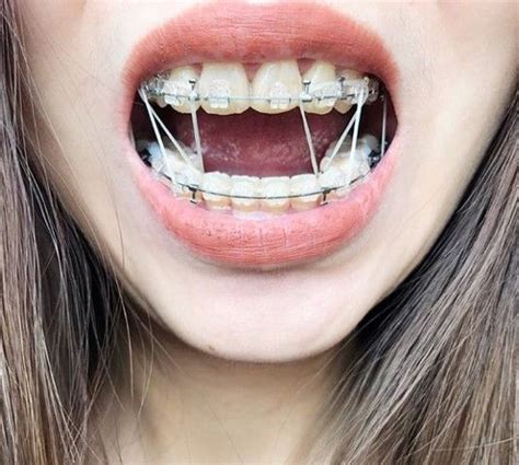 Clear Braces With Black Bands | BRACES POST