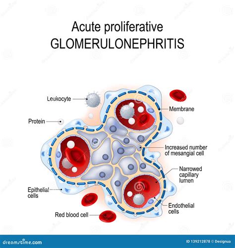 Glomerulonephritis Cartoons, Illustrations & Vector Stock Images - 273 ...