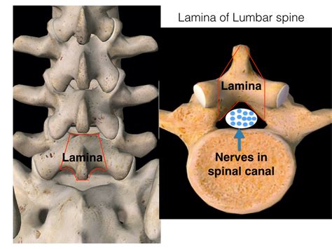 Lumbar laminectomy - Indications, results and cost - neurosurgerypro.com