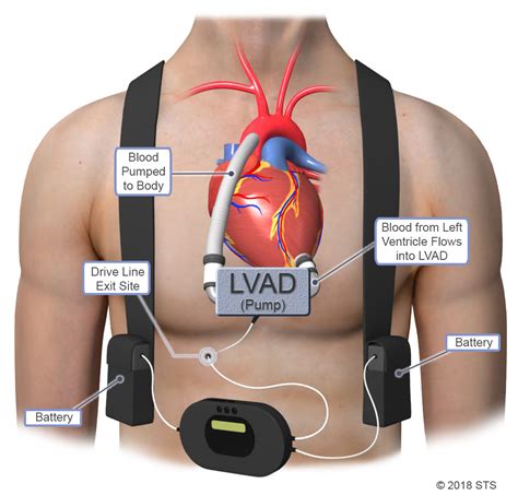 Left Ventricular Assist Device - Newport Cardiac & Thoracic Surgery