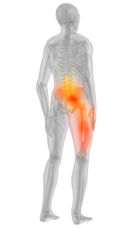 Spondylolisthesis | Total Spine & Brain Institute