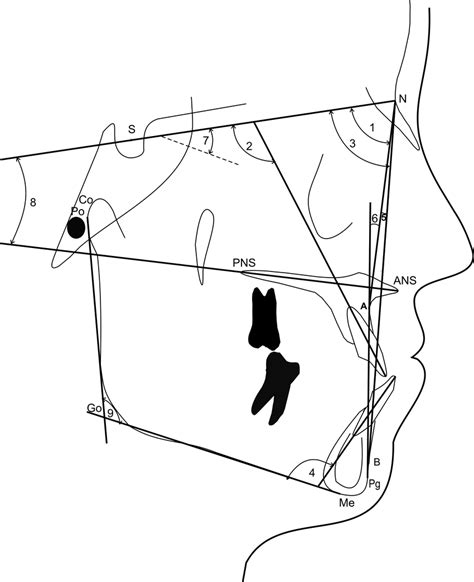 Angular measurements. (1) SNA. (2) Maxillary incisor-SN. (3) SNB. (4)... | Download Scientific ...