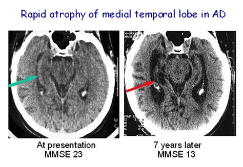 Rapid atrophy of the medial temporal lobe of the brain at the presentation of Alzheimer's ...