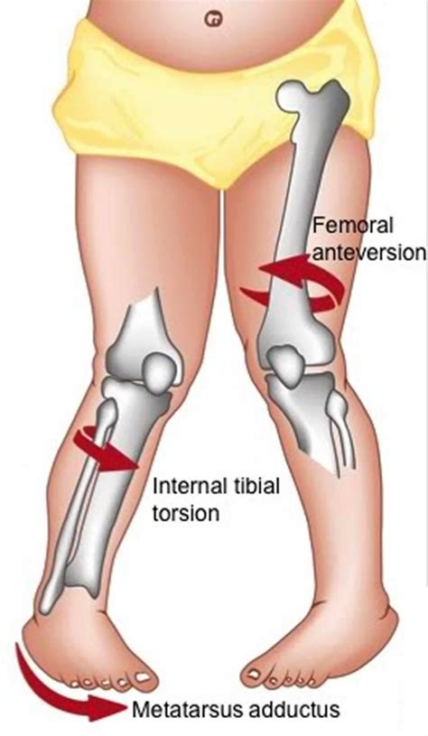 Femoral anteversion causes, symptoms, diagnosis, treatment & prognosis