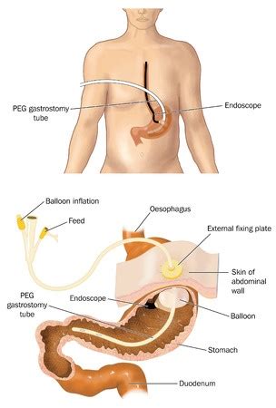 Percutaneous Gastrostomy - Treatment in Israel | D.R.A Medical