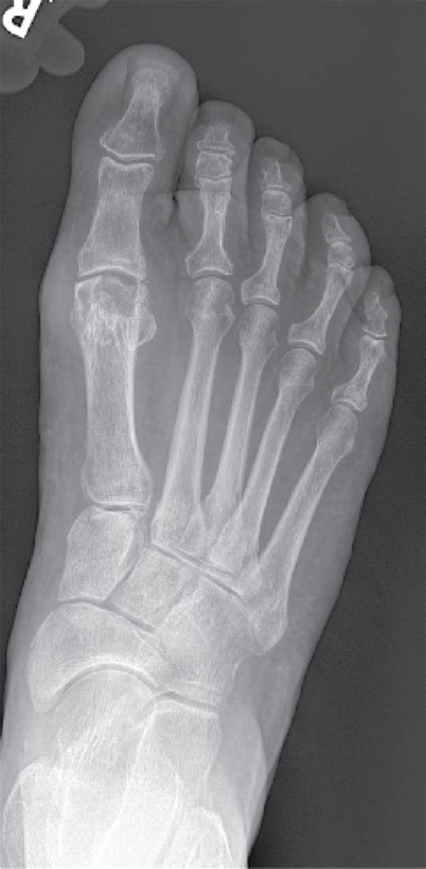 3D-printed hallux and lesser metatarsophalangeal joint replacement | Musculoskeletal Key