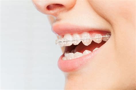 Can You Get Bottom Braces Only? - Suffolk Pediatric Dentistry