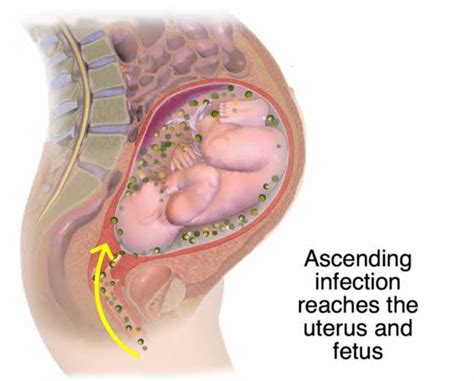 Intrauterine infections - Africa Digital Clinic