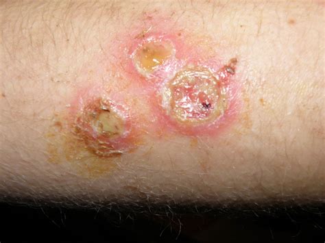 Staph Infection After A Burn - Northeast School of Botanical Medicine