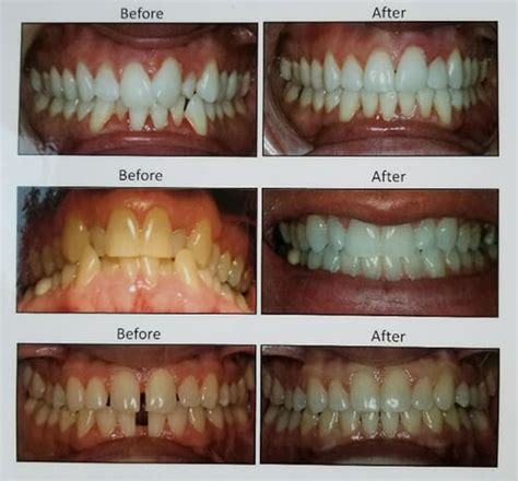 Straighten your teeth with Invisalign! - Functional Biological Holistic ...