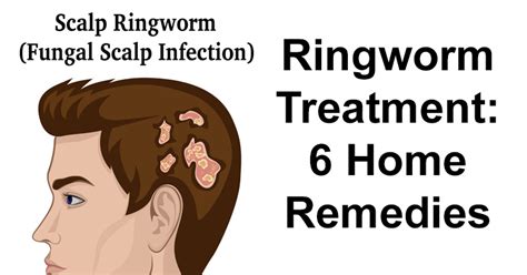 Ringworm Treatment Home Remedies For Humans