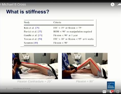 Arthrofibrosis of the Knee following Arthroplasty — OrthopaedicPrinciples.com