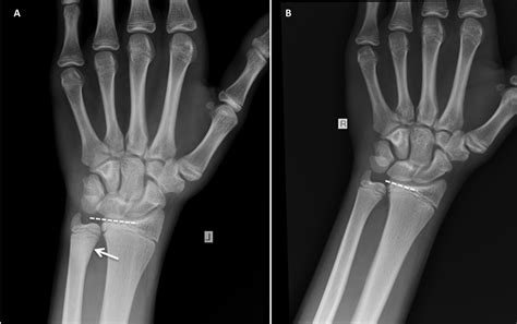 Cureus Isolated Salter Harris Type Ii Fracture Of The Distal Ulna | My ...