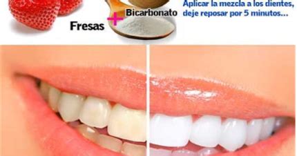 Limpieza Dental Profunda Casera