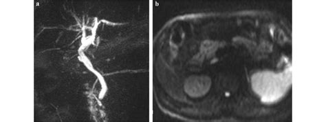 a Postoperative MRI image of the biliary tree. b No evidence of... | Download Scientific Diagram