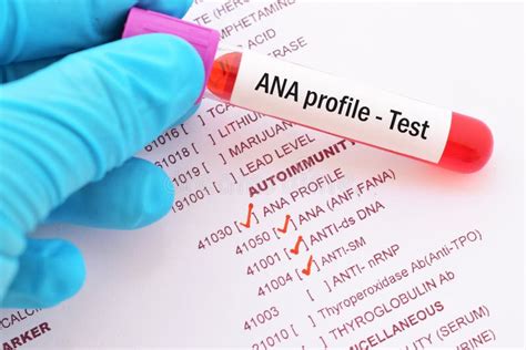 Blood for ANA profile test stock photo. Image of exam - 109111680