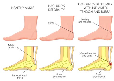 Insertional Achilles Tendonitis | Insertional Achilles Tendinopathy