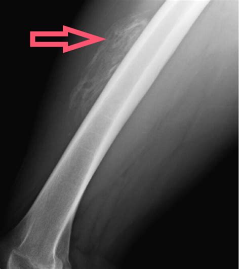 Myositis Ossificans: A Complication of Muscle Injury - Sport Doctor London