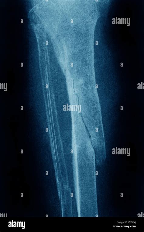 FRACTURED LEG, X-RAY Stock Photo - Alamy