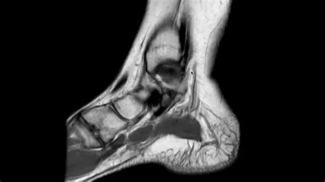 Ankle MRI anatomy - YouTube