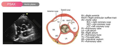 Aortic Valve Thickness