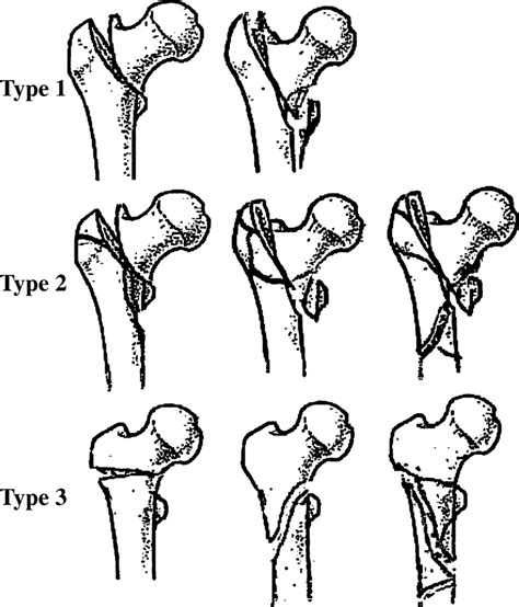 Three types of extra-articular proximal femur fracture | Download Scientific Diagram