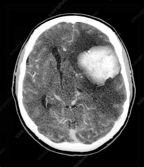 What Is A Ct Scan Of The Brain