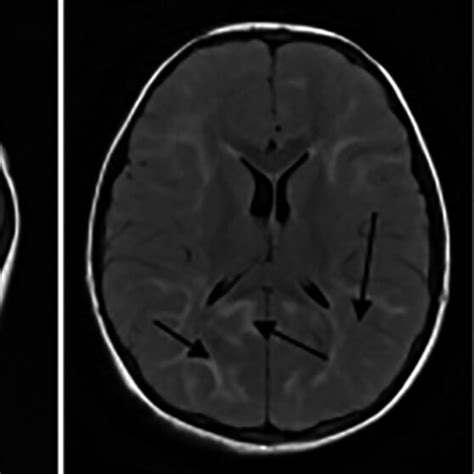 MRI brain T2-weighted and FLAIR images, showing increased signals... | Download Scientific Diagram