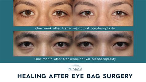 Lower Blepharoplasty Recovery Process | Dr. Prasad Blog