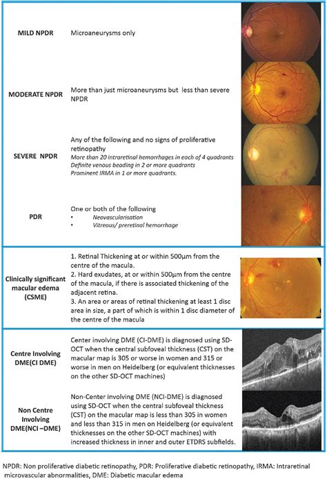 Diabetic macular edema treatment guidelines in India: All In... : Indian Journal of Ophthalmology