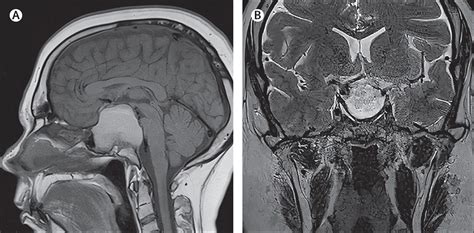 Pituitary apoplexy, but not as we thought: a xanthogranuloma rather ...