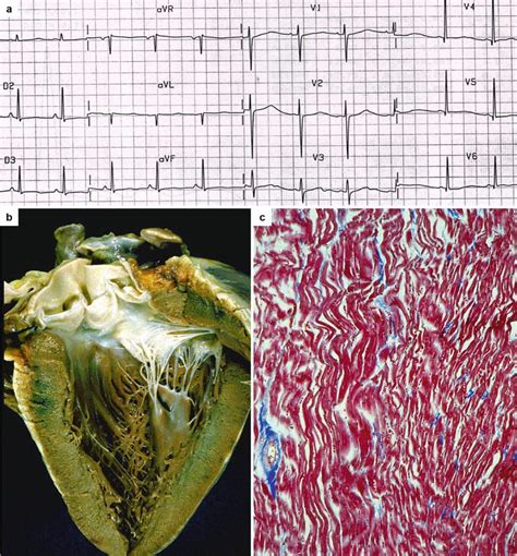 Ion Channel Disease | Thoracic Key