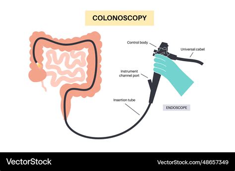 Colonoscopy medical procedure Royalty Free Vector Image