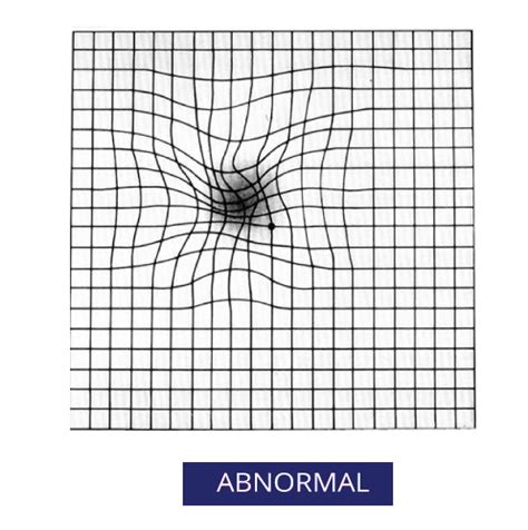 amsler-abnormal - North Queenland Eye Clinic