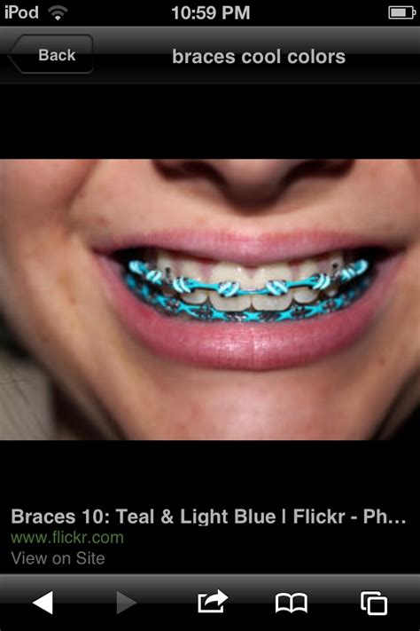 1000+ images about Braces on Pinterest | Ceramic braces, Light teal and ...