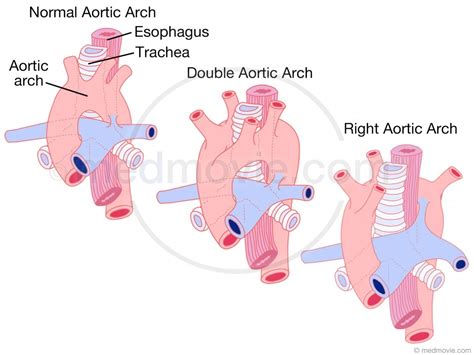 Medmovie.com | Aortic Arch Malformations